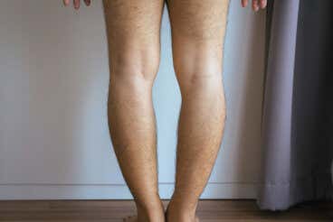 Genu varo o piernas arqueadas: ¿por qué ocurre y cómo se trata?