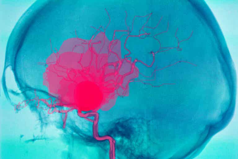 ¿Qué es una hemorragia cerebral y por qué puede ocurrir?