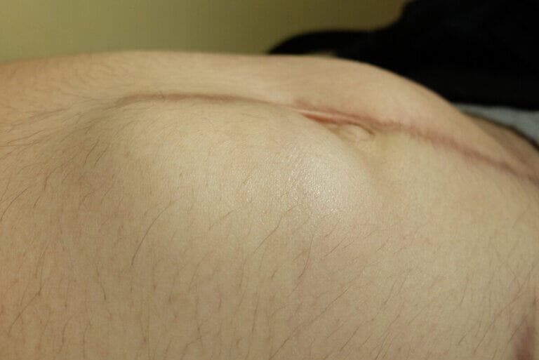 Hernia incisional: causas, síntomas y tratamientos