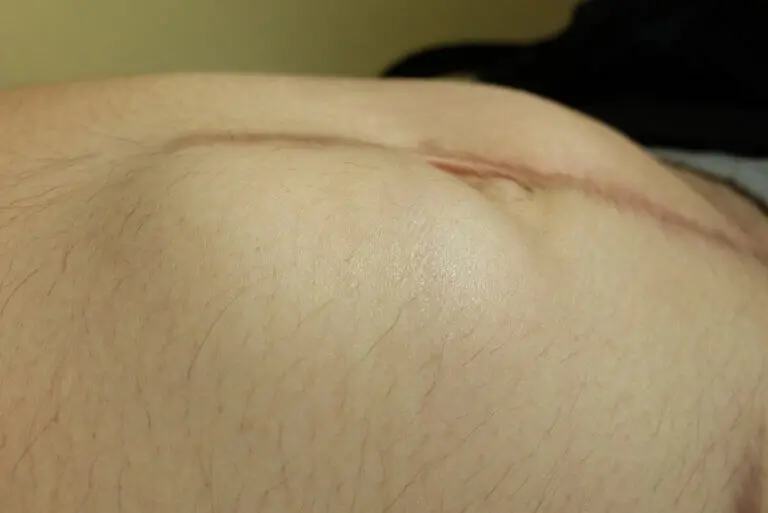 Hernia incisional: causas, síntomas y tratamientos