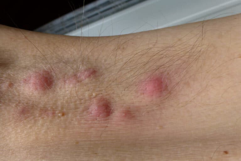 ¿Una dieta puede mejorar la hidradenitis supurativa?
