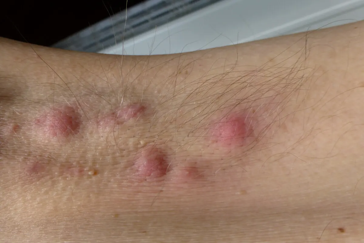 Nódulos de la hidradenitis supurativa.