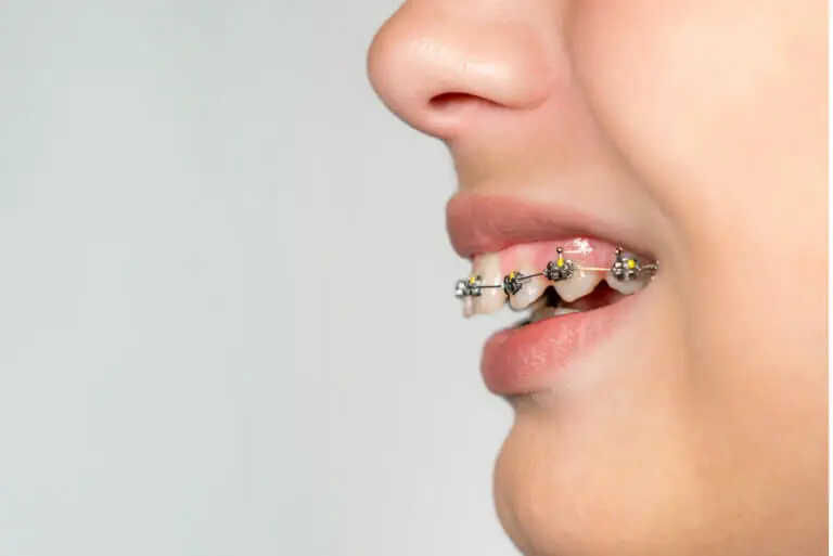 ¿Qué es la sobremordida y cómo se trata?