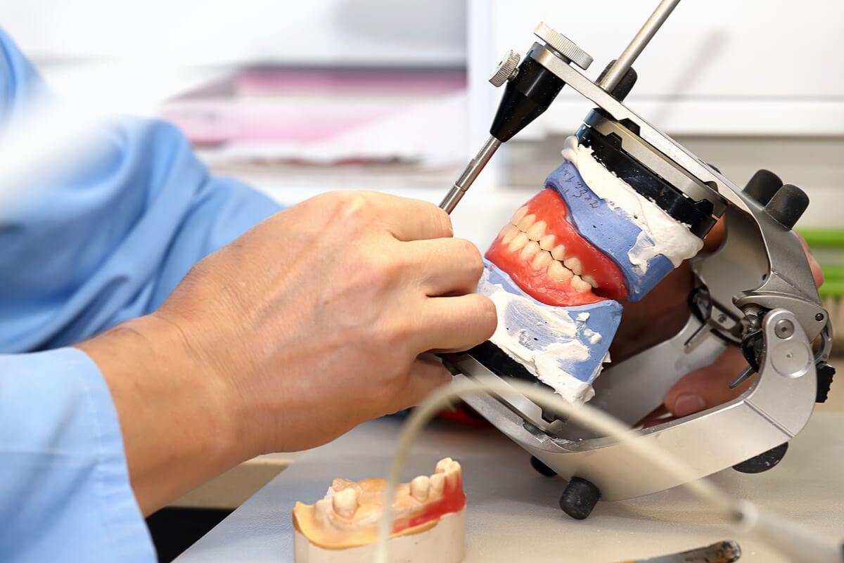 Prótesis sobre implantes dentales: ¿qué son y qué tipos existen?