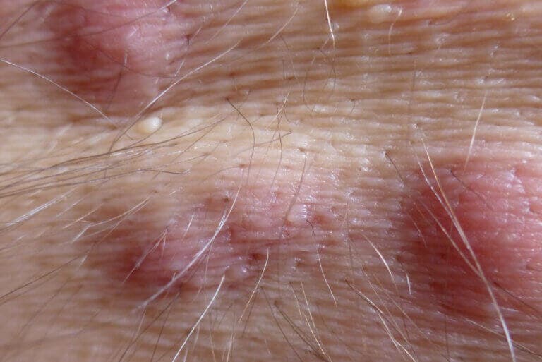 Hidradenitis supurativa: ¿qué es y cuáles son sus síntomas?