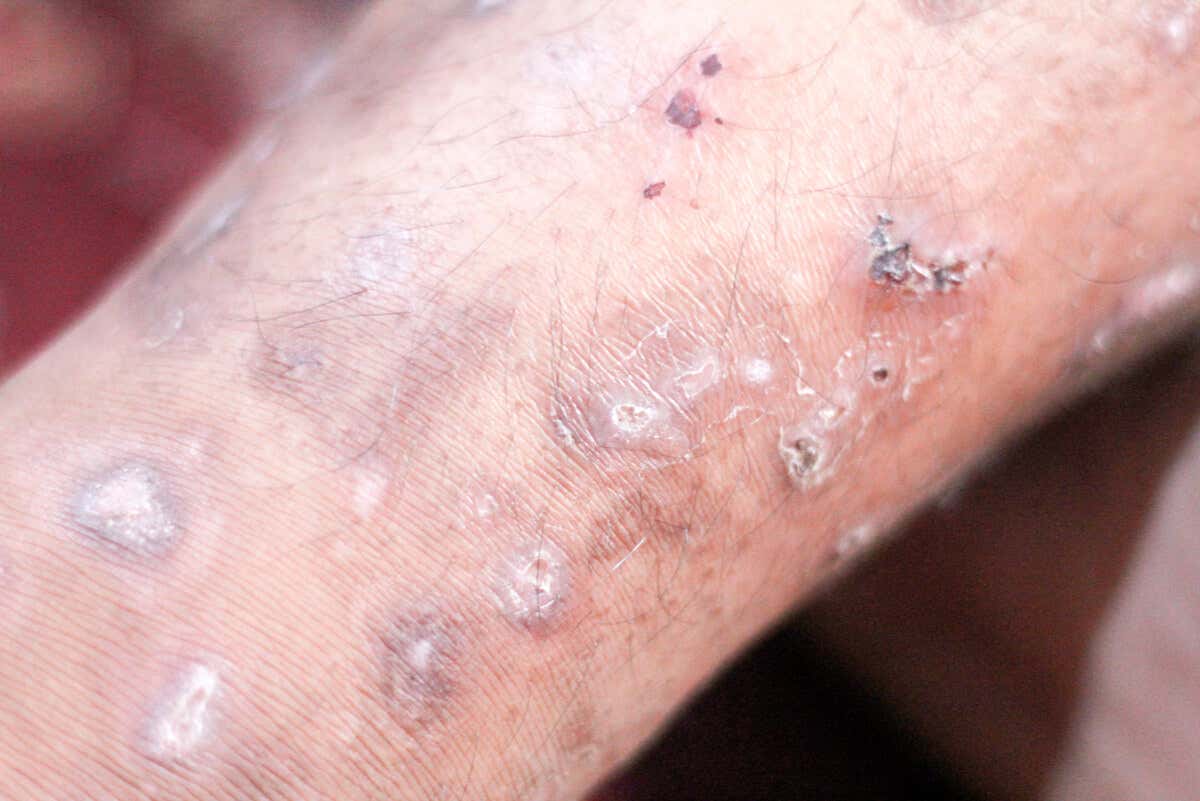 Lesioni da scabbia nell'uomo con macchie rosse sulla pelle.