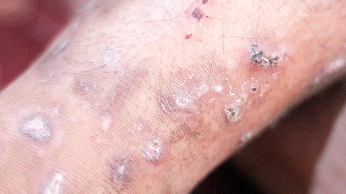 Taches rouges sur la peau : 25 causes possibles et traitements