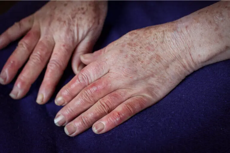 Enfermedad de Buerger: causas, síntomas y tratamientos