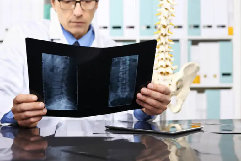 ¿Cuándo es necesario operar una hernia discal?