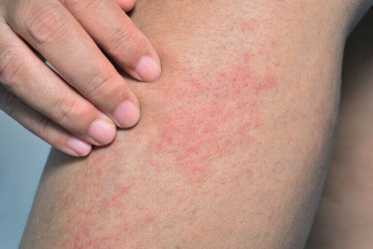 Piel moteada: ¿en qué consiste y cuáles son sus causas?
