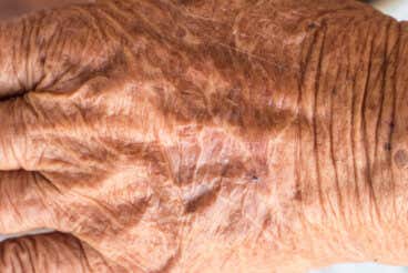 ¿Qué es la piel de crepé y cómo se puede evitar?