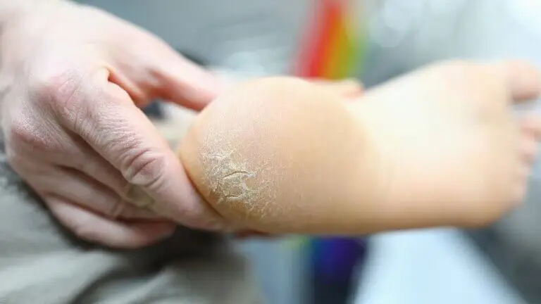 10 remedios caseros definitivos para los talones agrietados