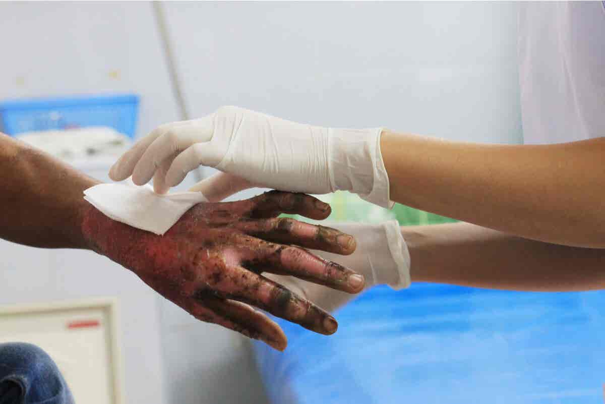 skin grafting for burn victims