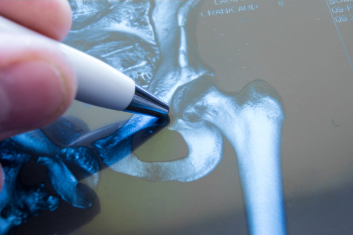 Radiografía para la artritis idiopática juvenil.