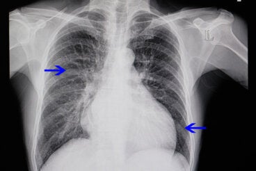 ¿Qué es la cardiomegalia y por qué ocurre?