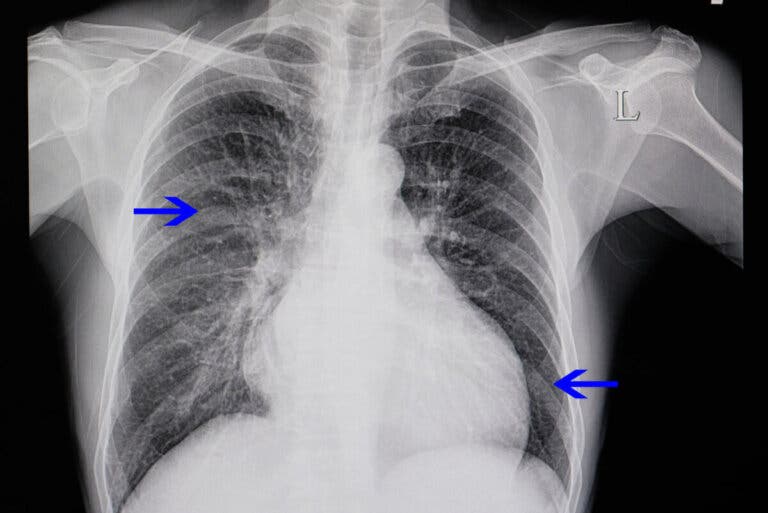 ¿Qué es la cardiomegalia y por qué ocurre?