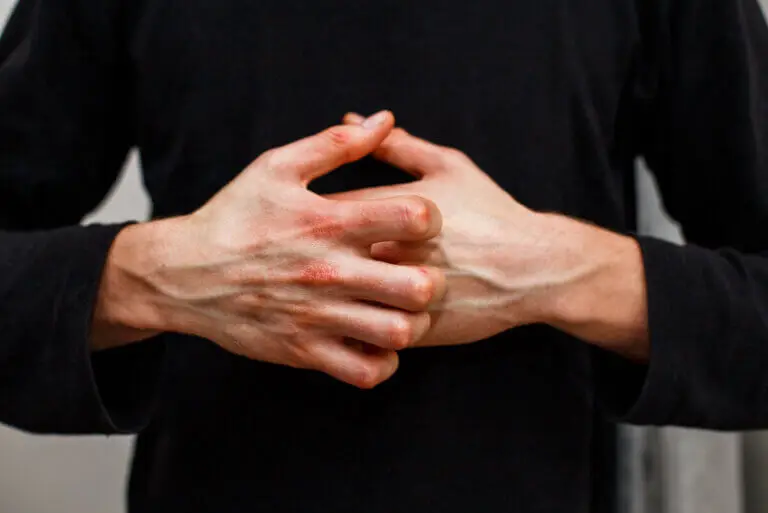 Enfermedad vascular del colágeno: síntomas y tratamiento