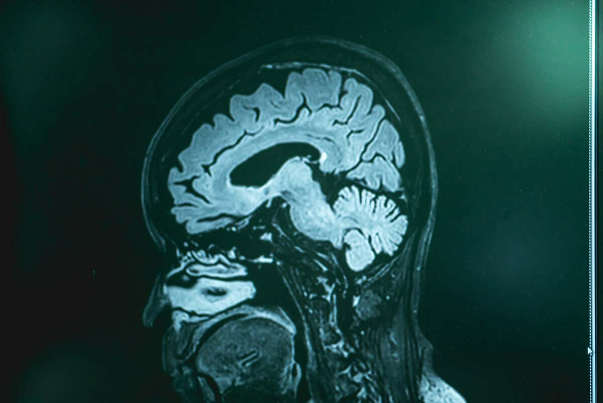 Exploración del cerebro en paciente con clonus.