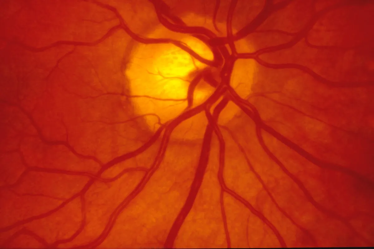 Retina y sus vasos sanguíneos.