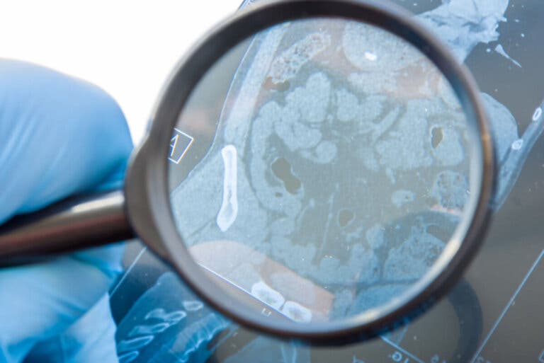 ¿Qué es una fístula gastrointestinal y qué la causa?