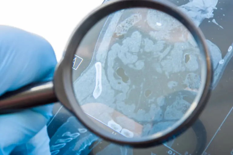 ¿Qué es una fístula gastrointestinal y qué la causa?