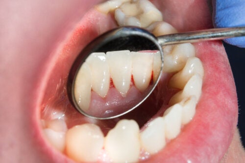 Cirugía periodontal: causas y proceso de recuperación