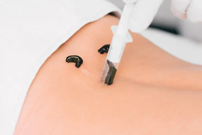 Terapia con sanguijuelas: qué es y cuál es su aplicación en la medicina
