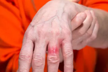 Alergia al níquel: causas, síntomas y precaución