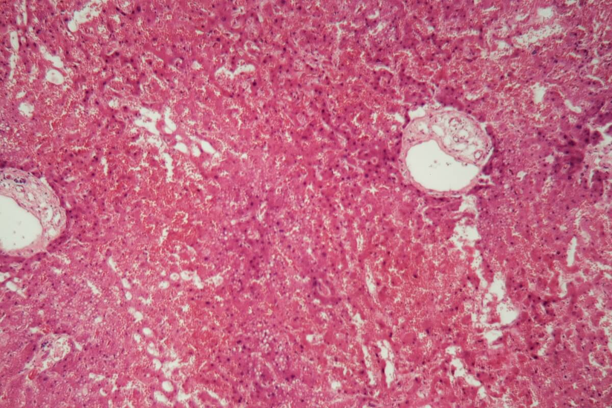 ¿Qué es la amiloidosis y cuáles son sus causas?