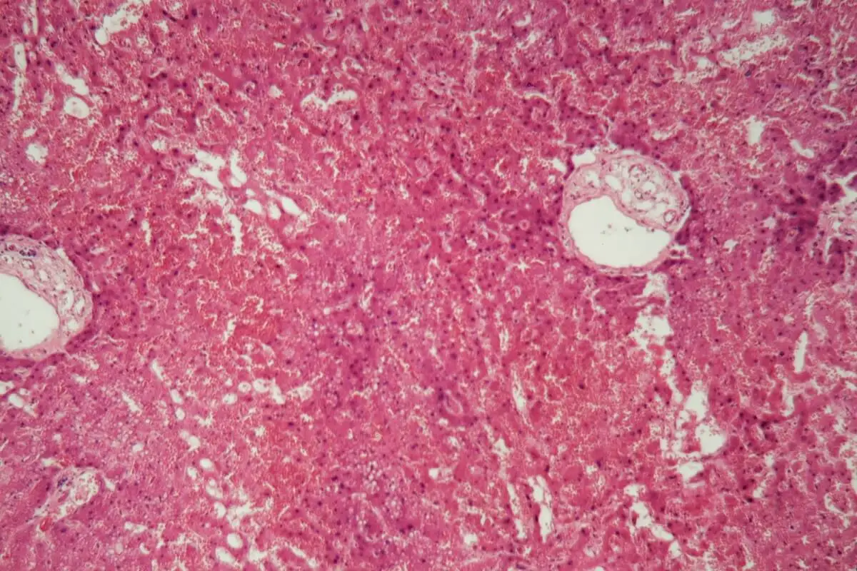 ¿Qué es la amiloidosis y cuáles son sus causas?