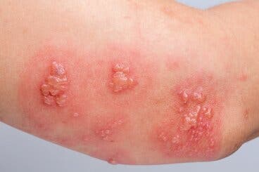 Penfigoide ampolloso: síntomas, causas y tratamiento