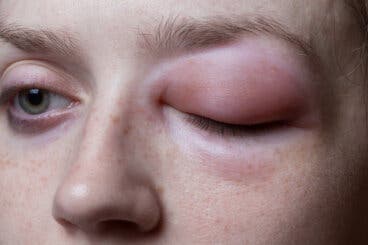 ¿Qué es el angioedema?