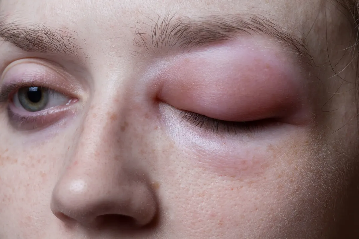 Angioedema en el párpado.