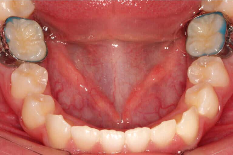 Bandas de ortodoncia: usos y beneficios