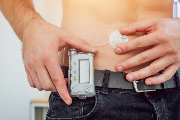 ¿Qué es una bomba de infusión de insulina?