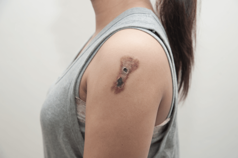 Carcinoma de células escamosas: causas, síntomas y tratamientos