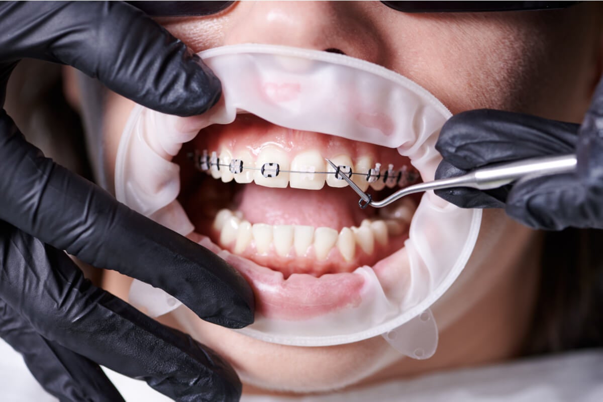 Tipos de ortodoncia para adultos mayores.