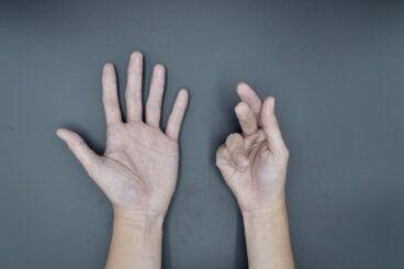 Contractura de Dupuytren: causas, síntomas y tratamientos