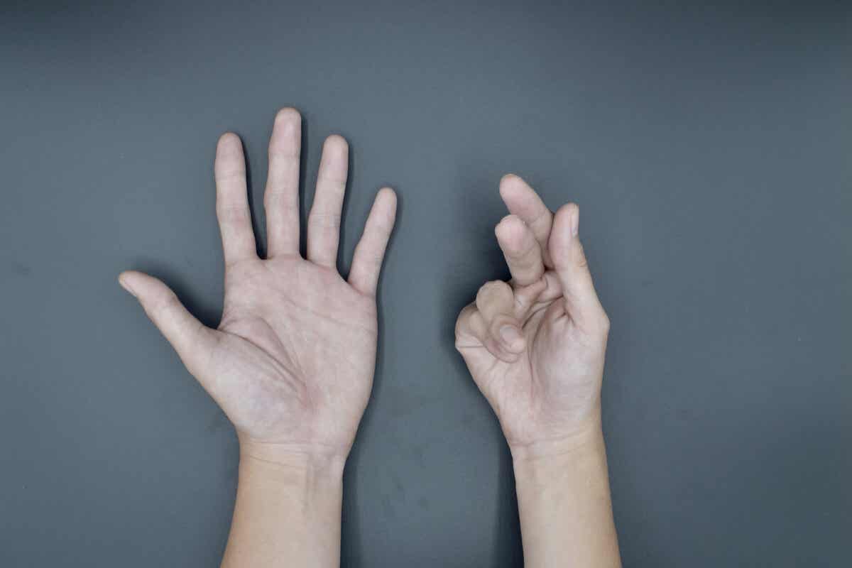 Stiff-Person-Syndrom - Muskelkrämpfe in den Fingern