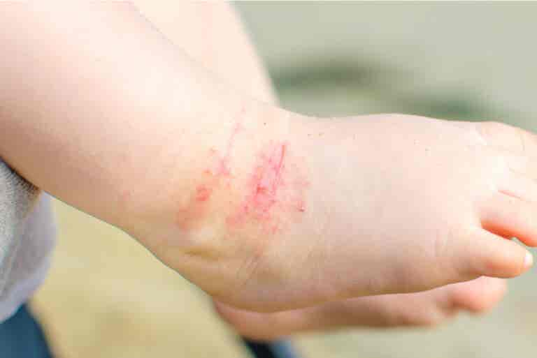 La dermatitis atópica suele ser una condición de por vida, dicen estudios