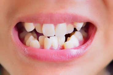 Maloclusión dental: causas, síntomas y tratamientos
