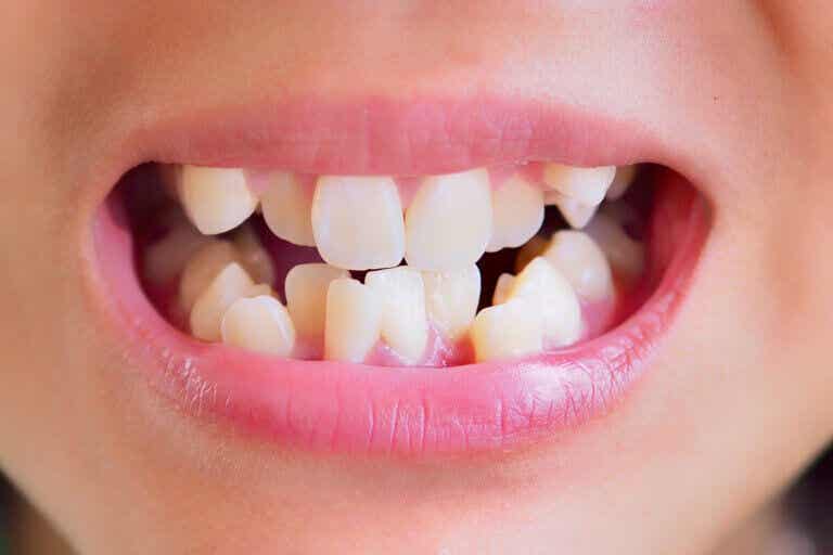 Maloclusión dental: causas, síntomas y tratamientos