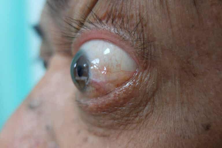 Enfermedad ocular tiroidea: síntomas, tratamientos y recomendaciones