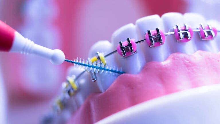 8 cuidados que toda persona con ortodoncia debe seguir