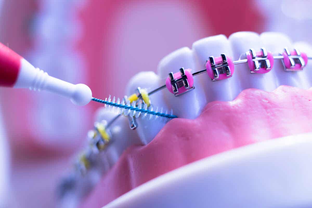 8 cuidados que toda persona con ortodoncia debe seguir