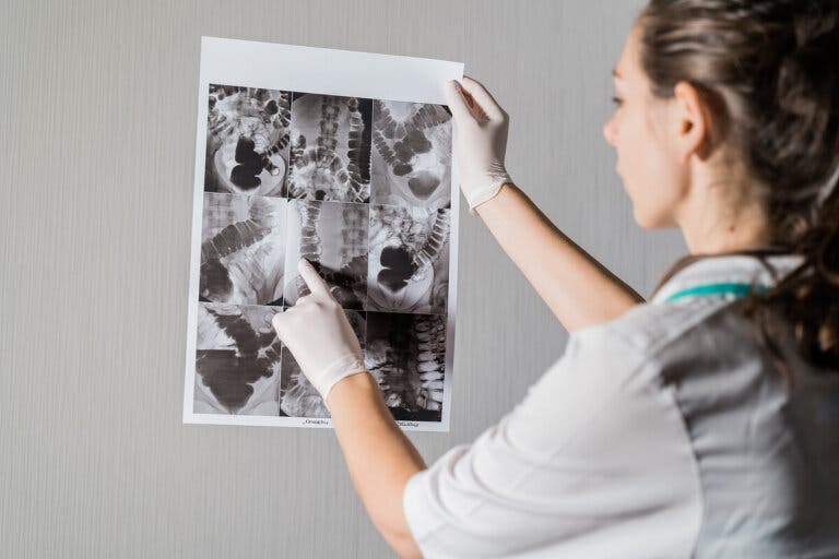 Perforación gastrointestinal: causas, síntomas y tratamientos