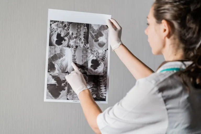 Perforación gastrointestinal: causas, síntomas y tratamientos