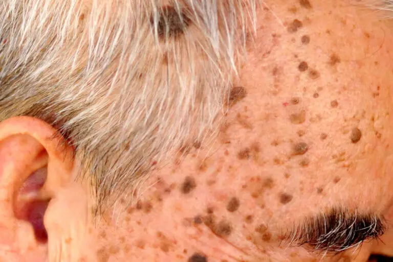¿Qué es la queratosis seborreica y cómo se puede tratar?
