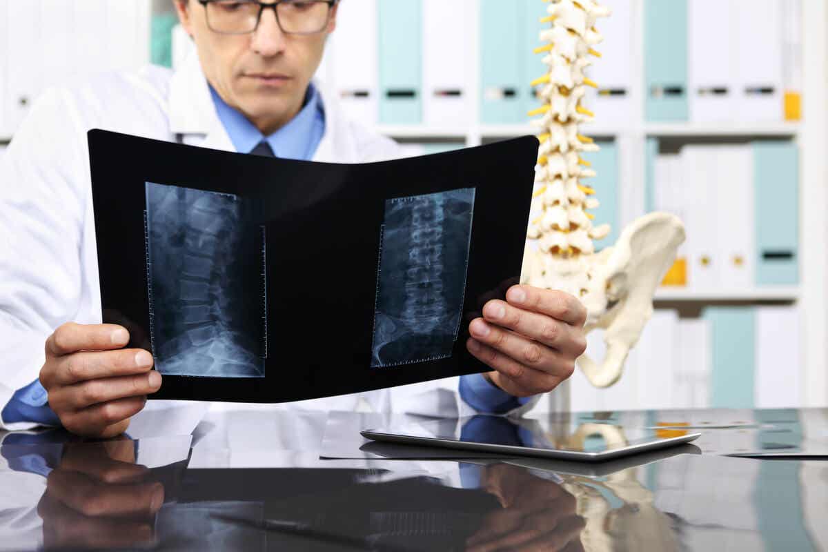 Radiografía que muestra osteofitos.