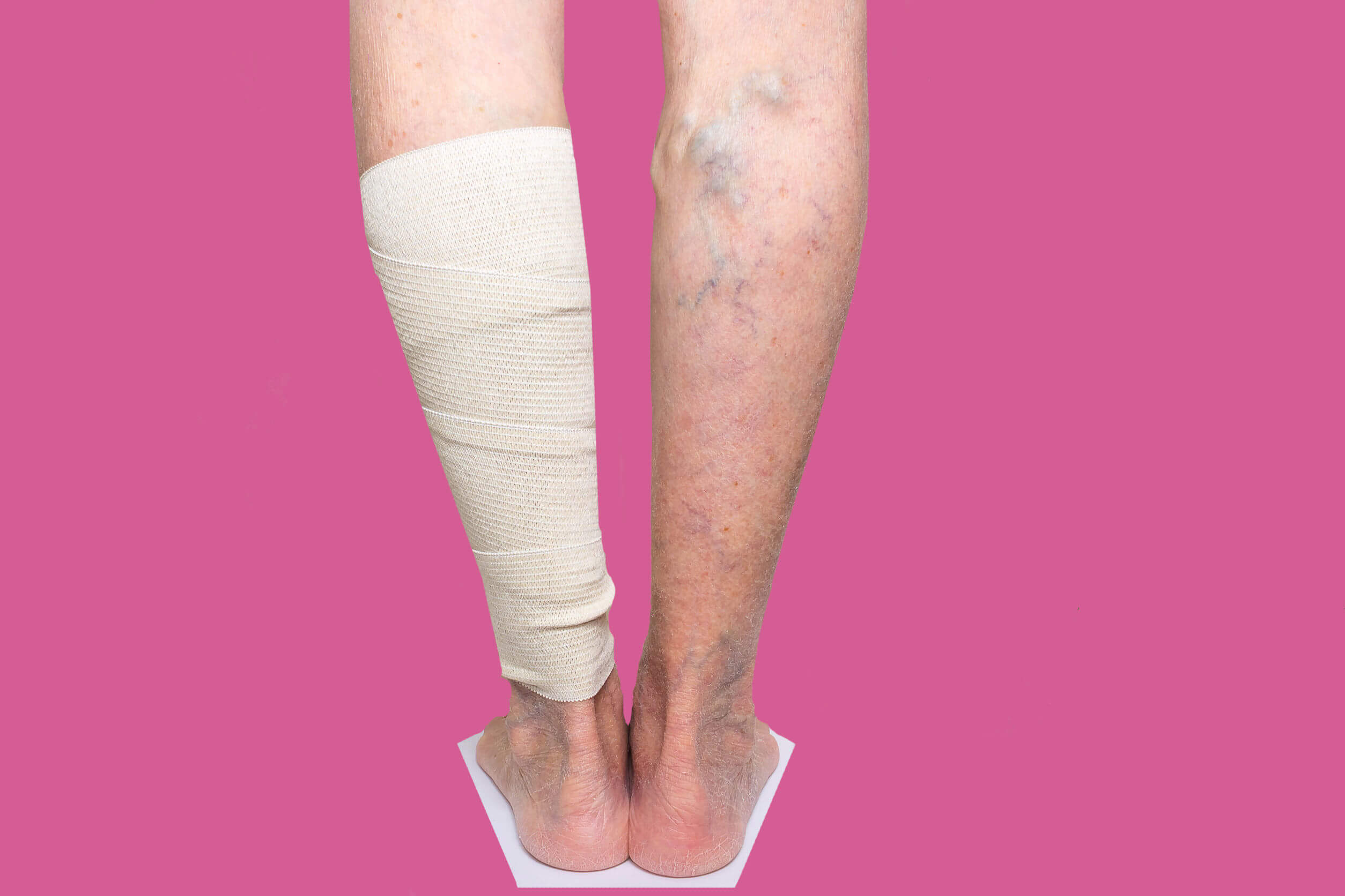 Cilostazol - Person mit einem verbundenen Bein und Krampfadern